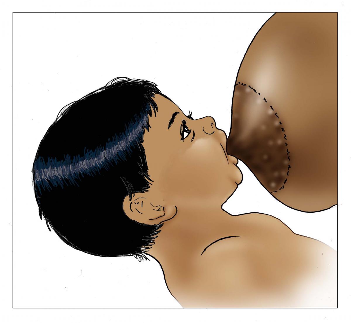 Breastfeeding - Breastfeeding poor attachment outside 0-6 mo - 03 - India