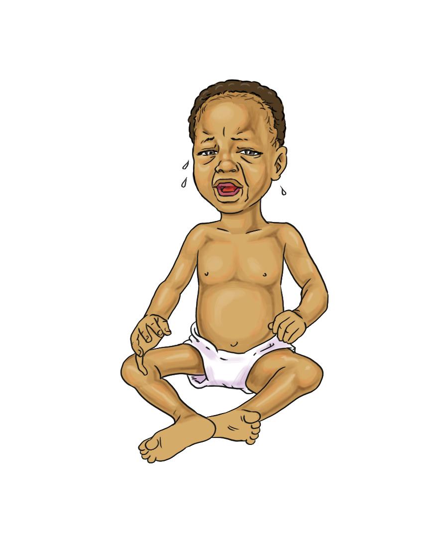Breastfeeding - Malnourished baby 0-6mo - 04 - Burkina Faso Breastfeeding - Malnourished baby 0-6mo - 04 - Burkina Faso