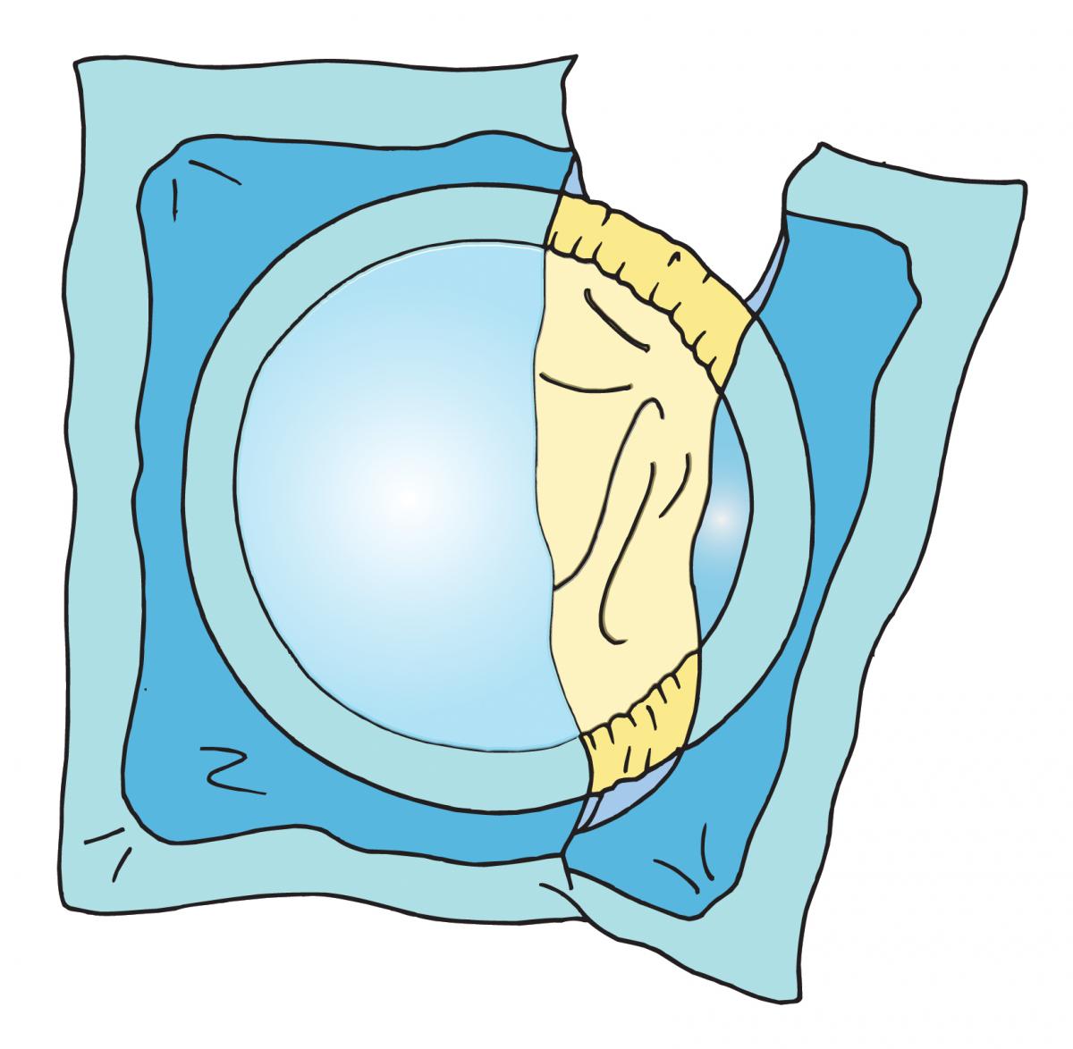 Family Planning - Birth Control-condom - 05 - Non-country specific