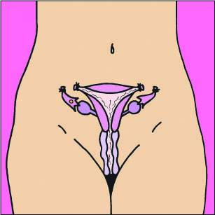 Family Planning - Female sterilization - 08 - Non-country specific