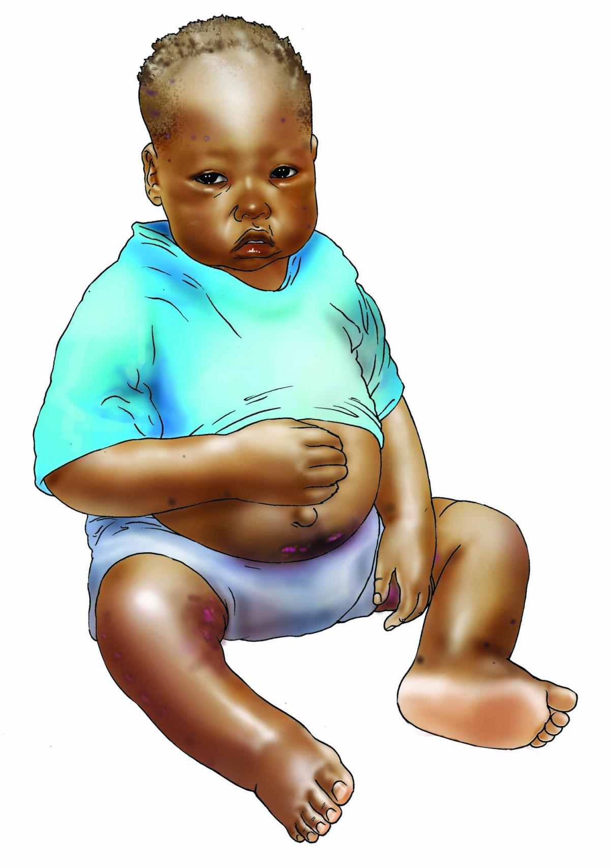 Sick Baby Health Care - Malnourished baby 6-9 mo - 01 - Non-country specific