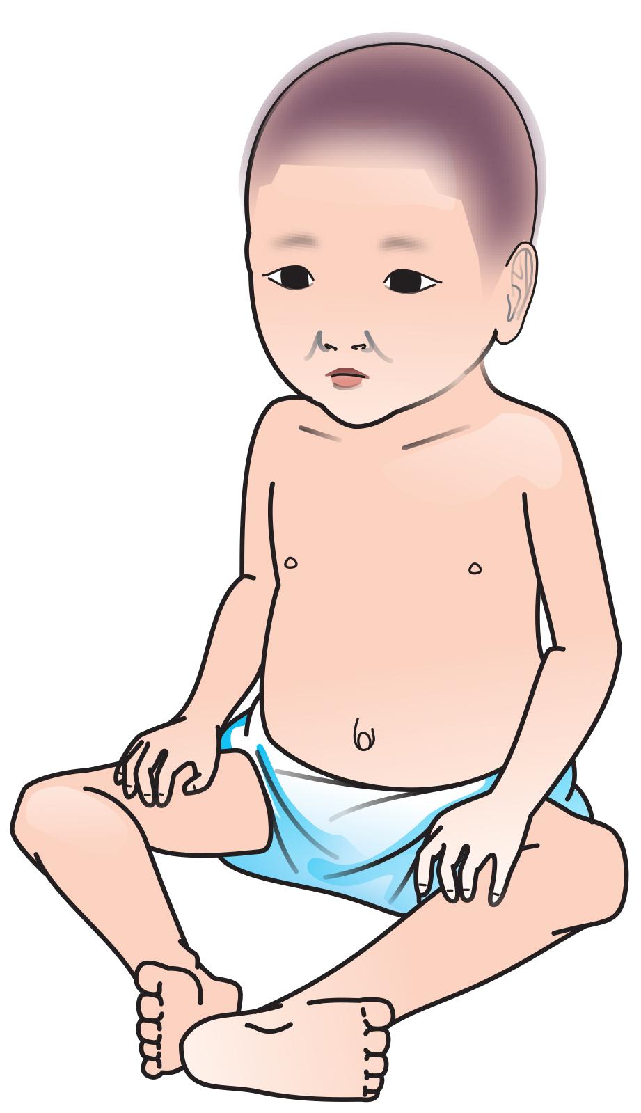People - Malnourished baby - 00 - Kyrgyz Republic People - Malnourished baby - 00 - Kyrgyz Republic