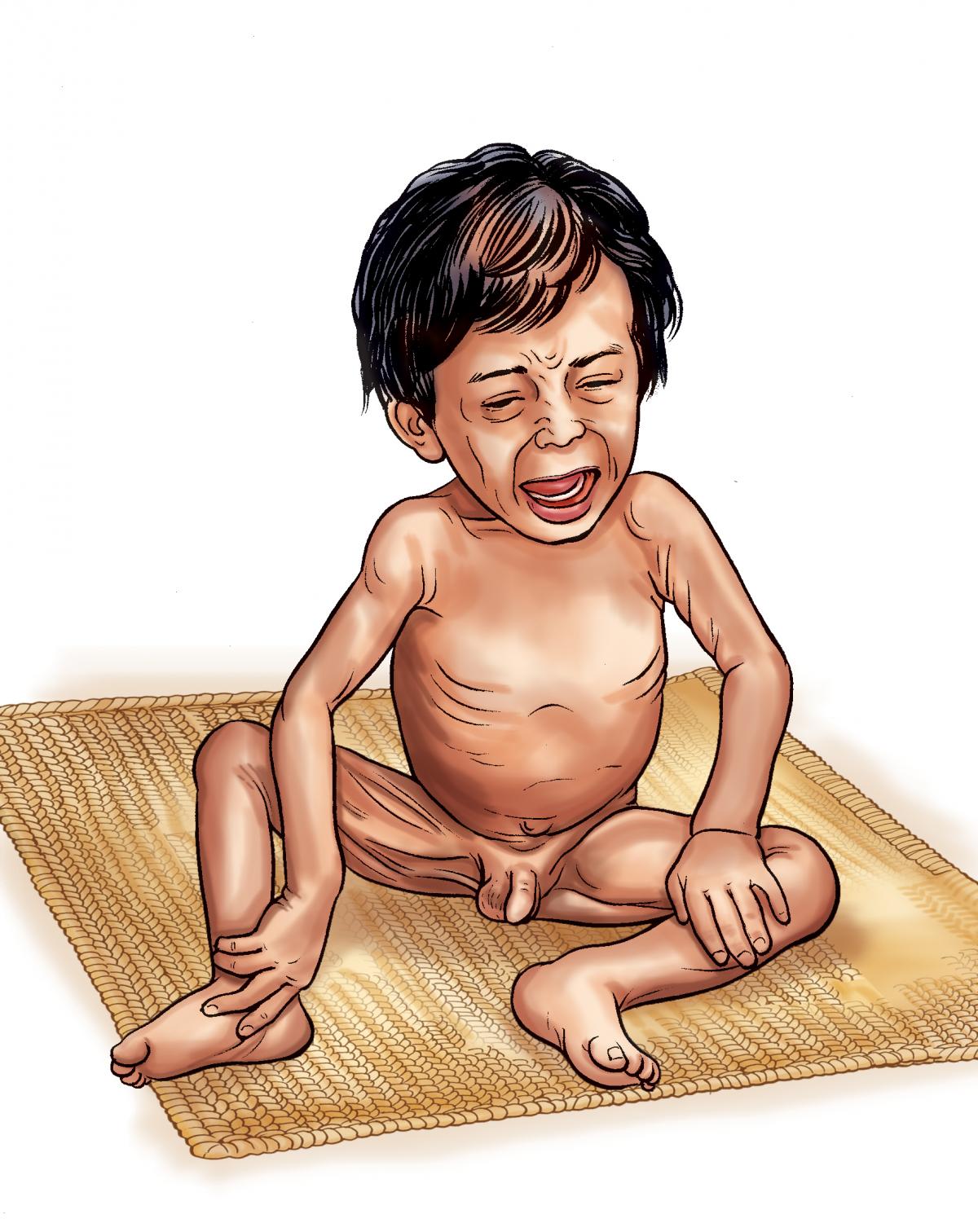 Sick Child Health - Malnourished baby - 00 - Nepal Sick Child Health - Malnourished baby - 00 - Nepal