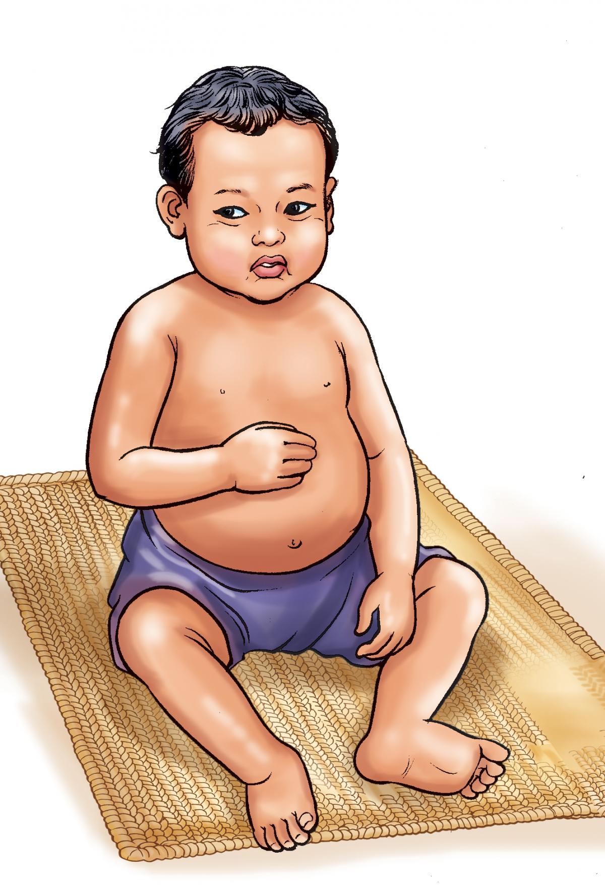 Sick Child Health - Malnourished baby 6-9 mo - 01 - Nepal Sick Child Health - Malnourished baby 6-9 mo - 01 - Nepal