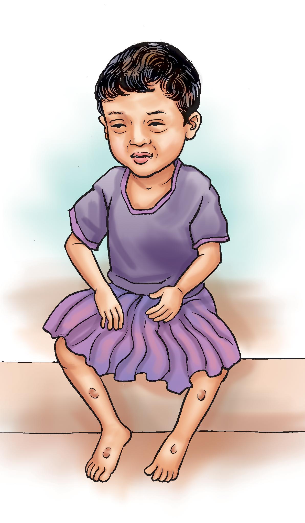 Sick Child Health - Malnourished toddler - 02 - Nepal Sick Child Health - Malnourished toddler - 02 - Nepal