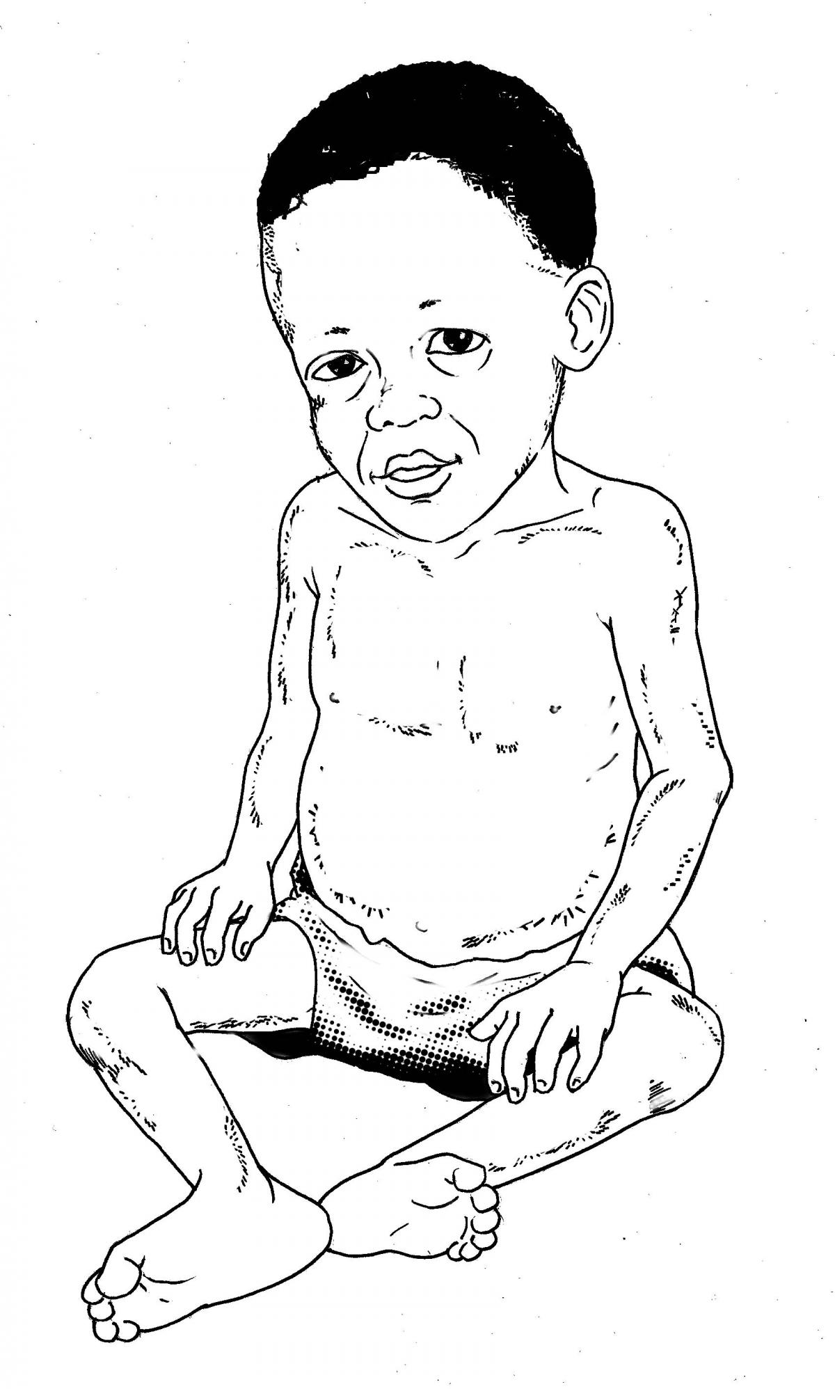 Sick Baby Health Care - Malnourished baby 6-24 mo - 00 - Non-country specific