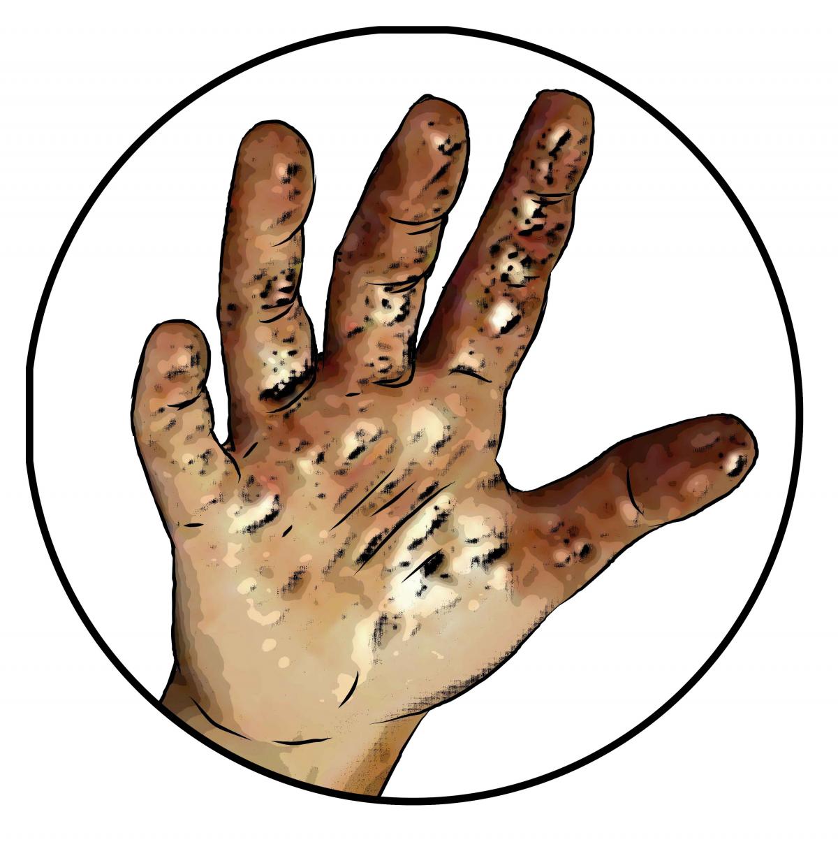 Hygiene - Child's dirty hand - 01 - Nigeria